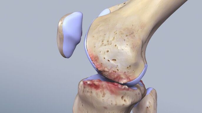 La struttura dell'articolazione del ginocchio è influenzata dalla patologia