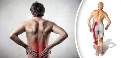 La sindrome del dolore con osteocondosi lombare trasuda sulle gambe