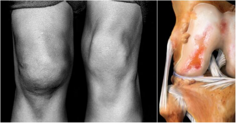Osteoartrite dell'articolazione del ginocchio e dell'articolazione del dolore