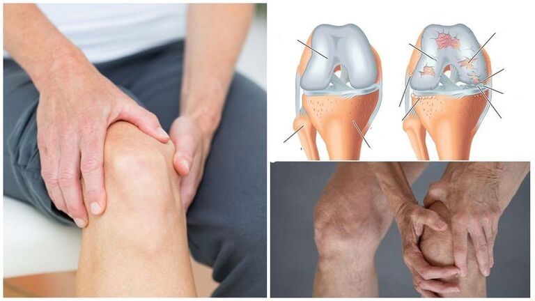 Sintomo del dolore al ginocchio per osteoartrosi dell'articolazione del ginocchio