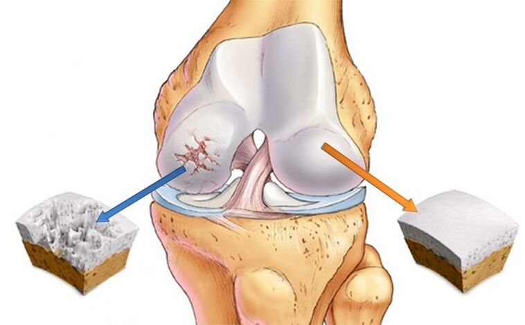 cartilagine normale e osteoartrosi