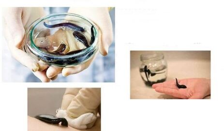 Irudoterapia per l'artrosi