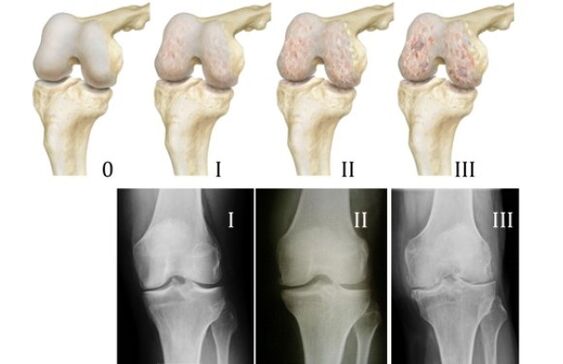 Metodi per diagnosticare l'artrosi del ginocchio